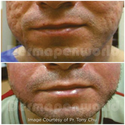 Acne_Scar_skin_needling_dermapen_before_after