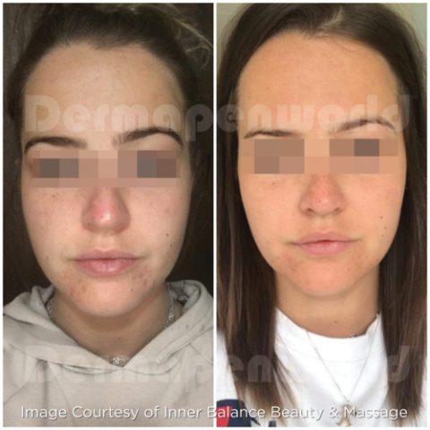 Acne_microneedling_dermapen_before_after-480x480