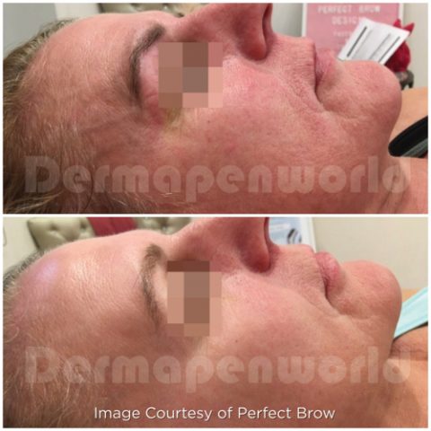 Ageing_microneedling_skin_before_after