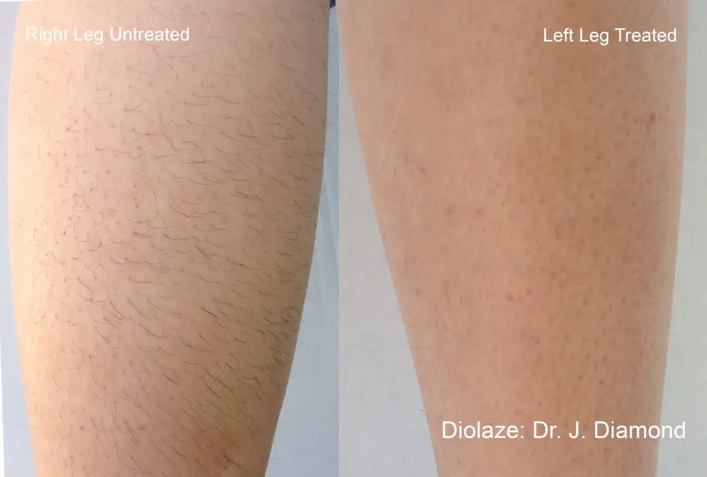 diolazexl-before-after-dr-j-diamond-preview-3