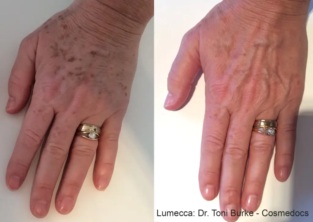 lumecca-before-after-dr-toni-burke-cosmedocs-preview-1