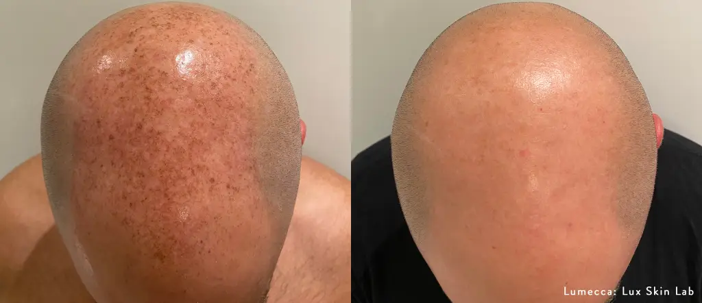 lumecca-before-after-lux-skin-lab-preview-1