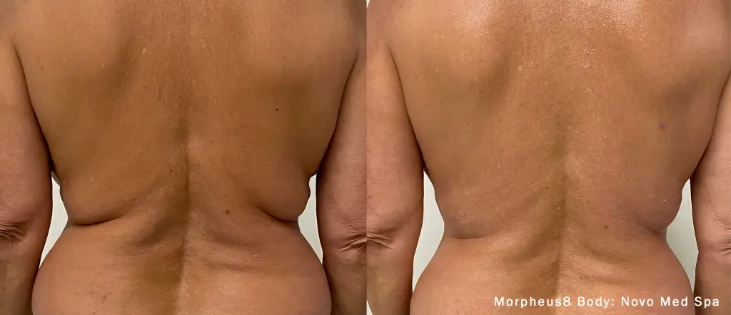 morpheus8-body-before-after-novo-medspa-preview-1